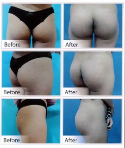 Buttock Augmentation with Implants – Verve Plastic Surgery
