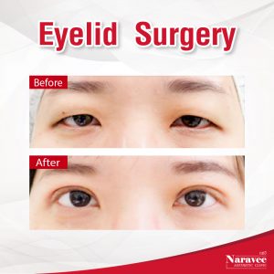 double eyelid surgery thailand price